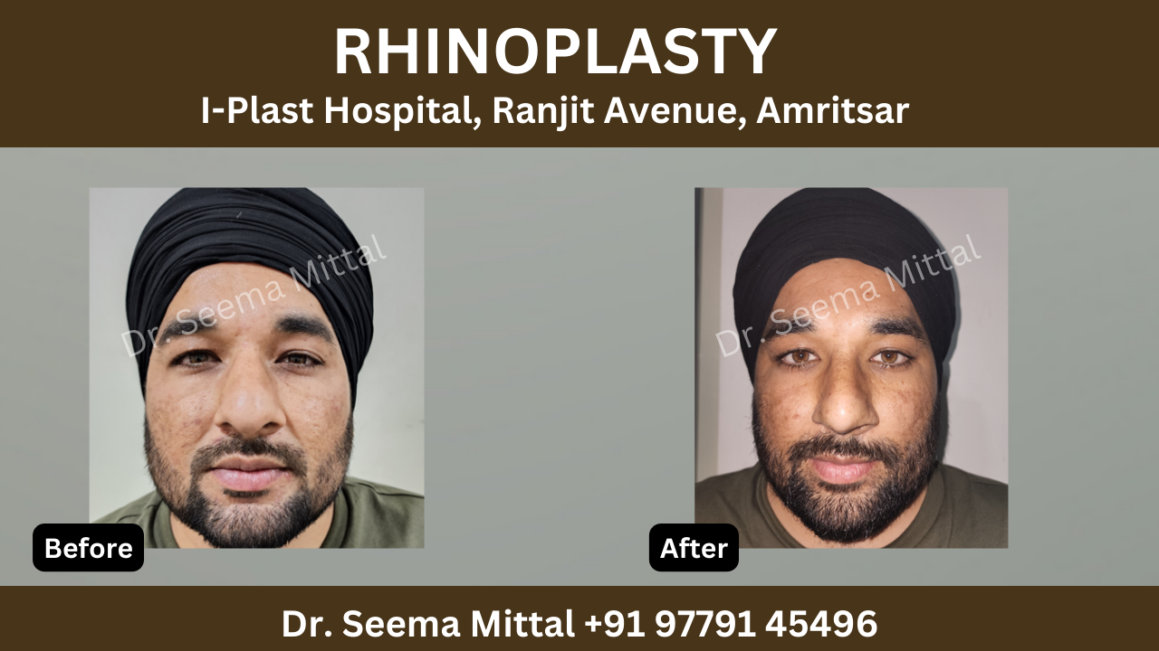 rhinoplasty in amritsar