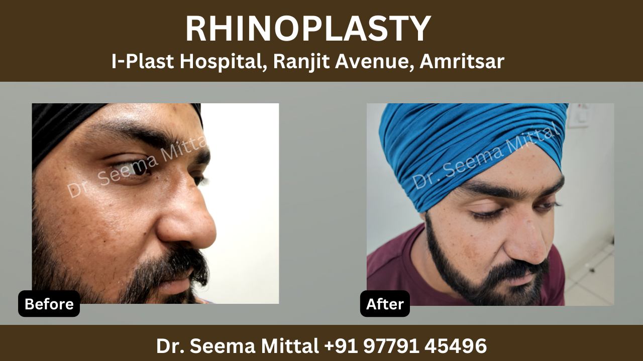 rhinoplasty in Jalandhar