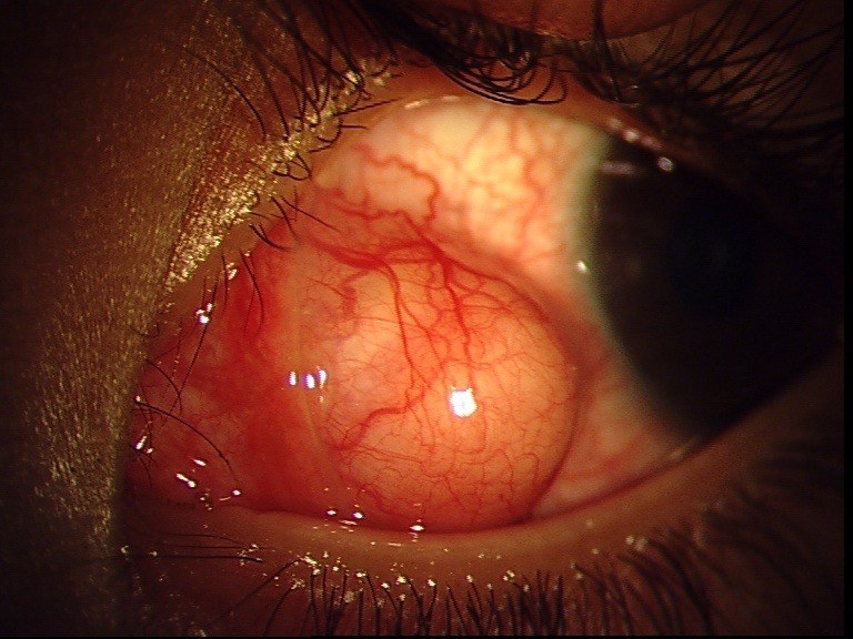 Inflamed eye muscle with a cyst beneath the surface of the eye