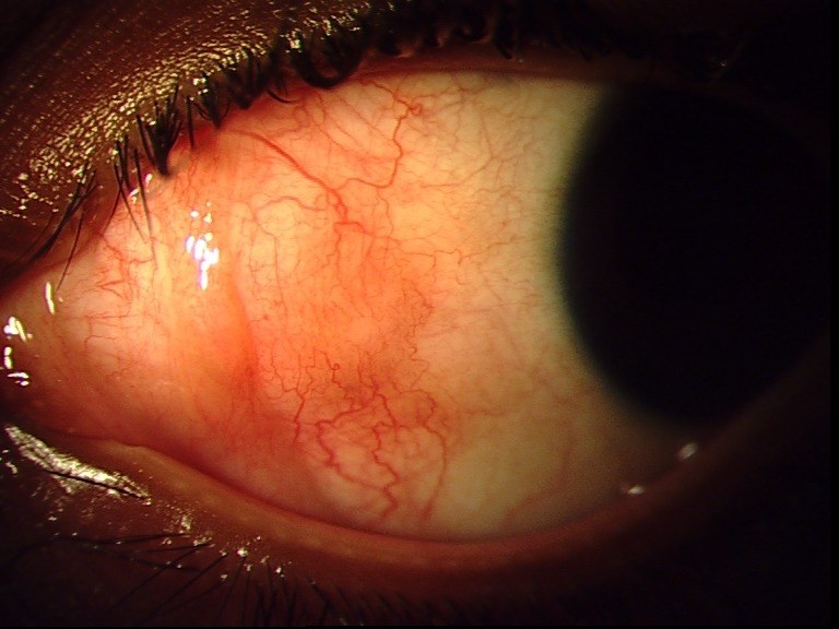 Redness over an inflamed eye muscle