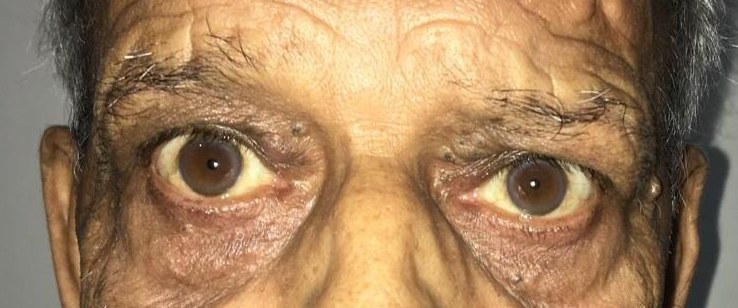 Bilateral Ptosis, after