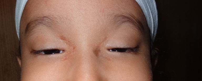 Blepharophimosis, after stage 1