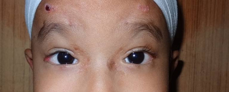 Blepharophimosis, after stage 2