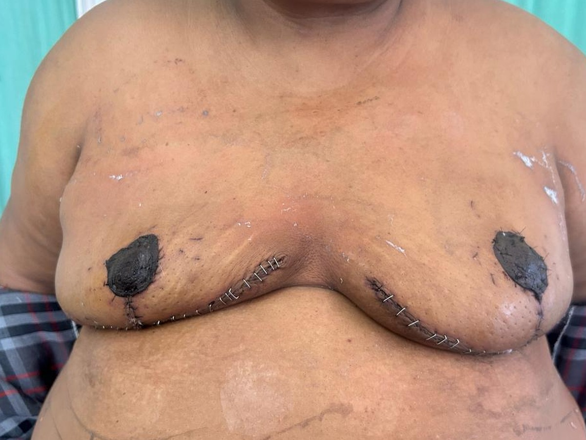 Breast Reduction, after