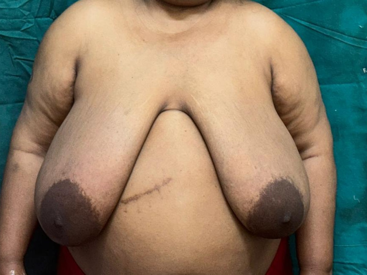 Breast Reduction, before