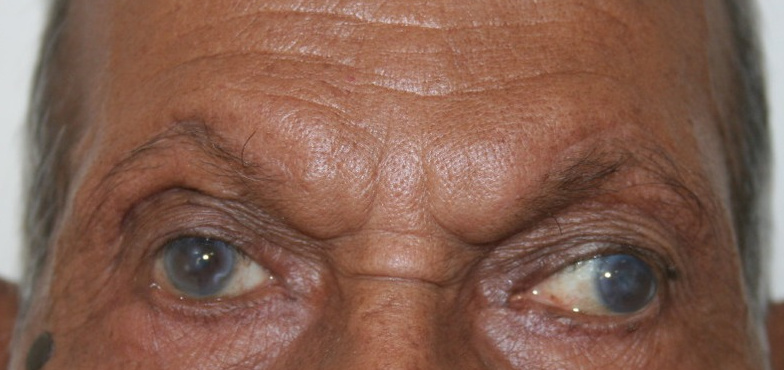 Browplasty + Blepharoplasty, after
