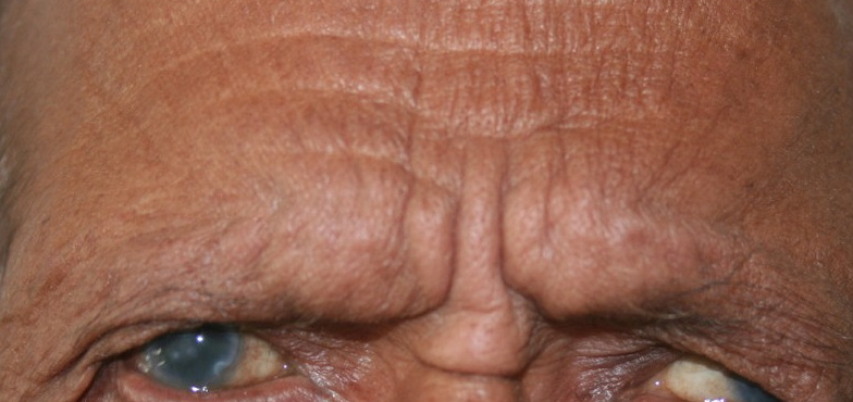 Browplasty + Blepharoplasty, before