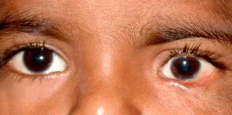 Cryptophthalmos, after
