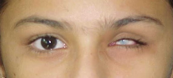 Custom Artificial Eye, before