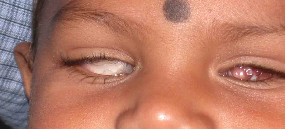 Custom Artificial Eye, before