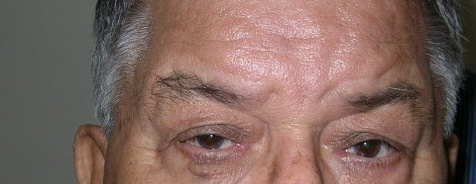 Entropion, after
