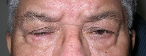 Entropion, before