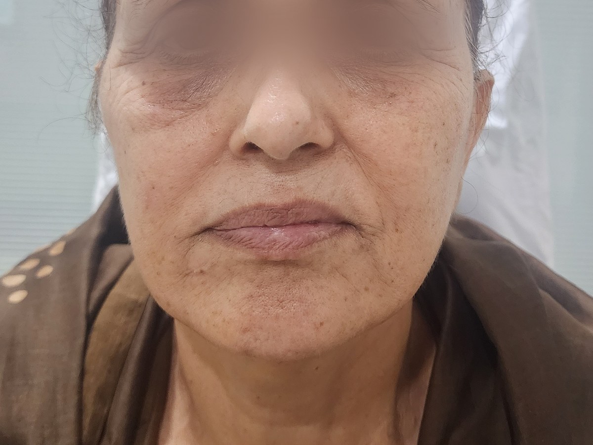 Face Lift, before