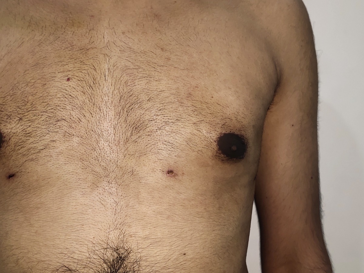 Gynecomastia, after