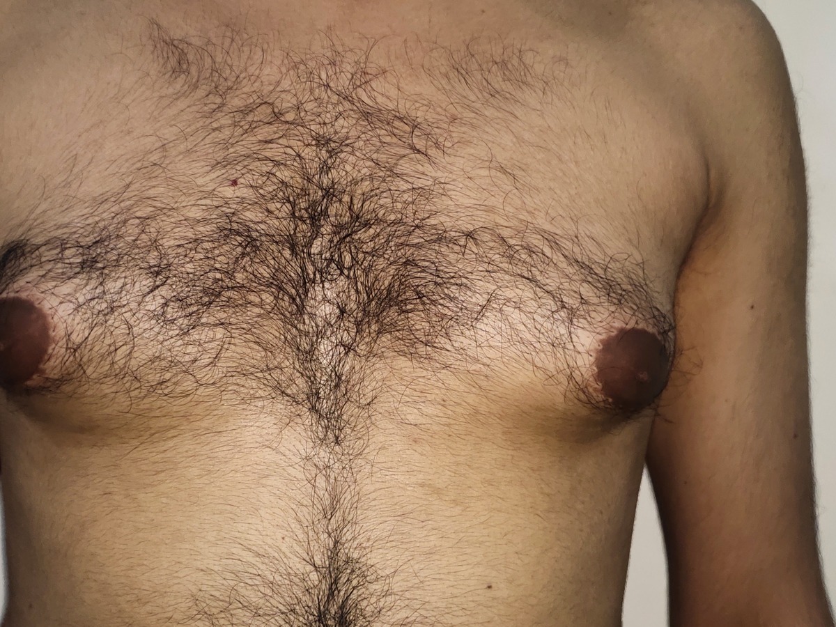 Gynecomastia, before