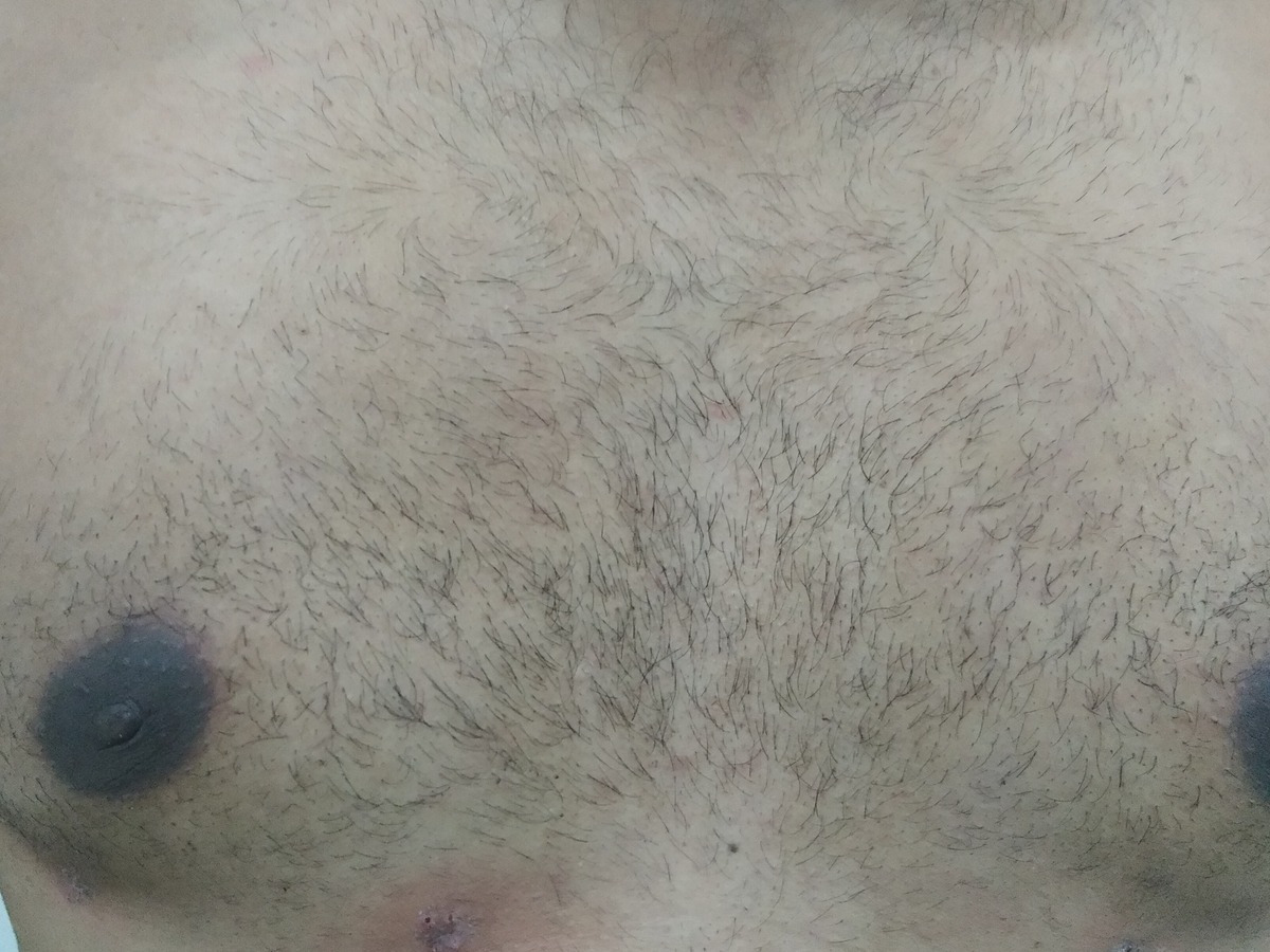Gynecomastia, after