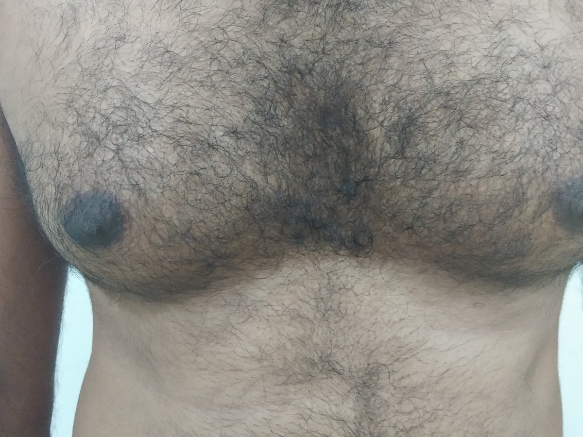 Gynecomastia, before