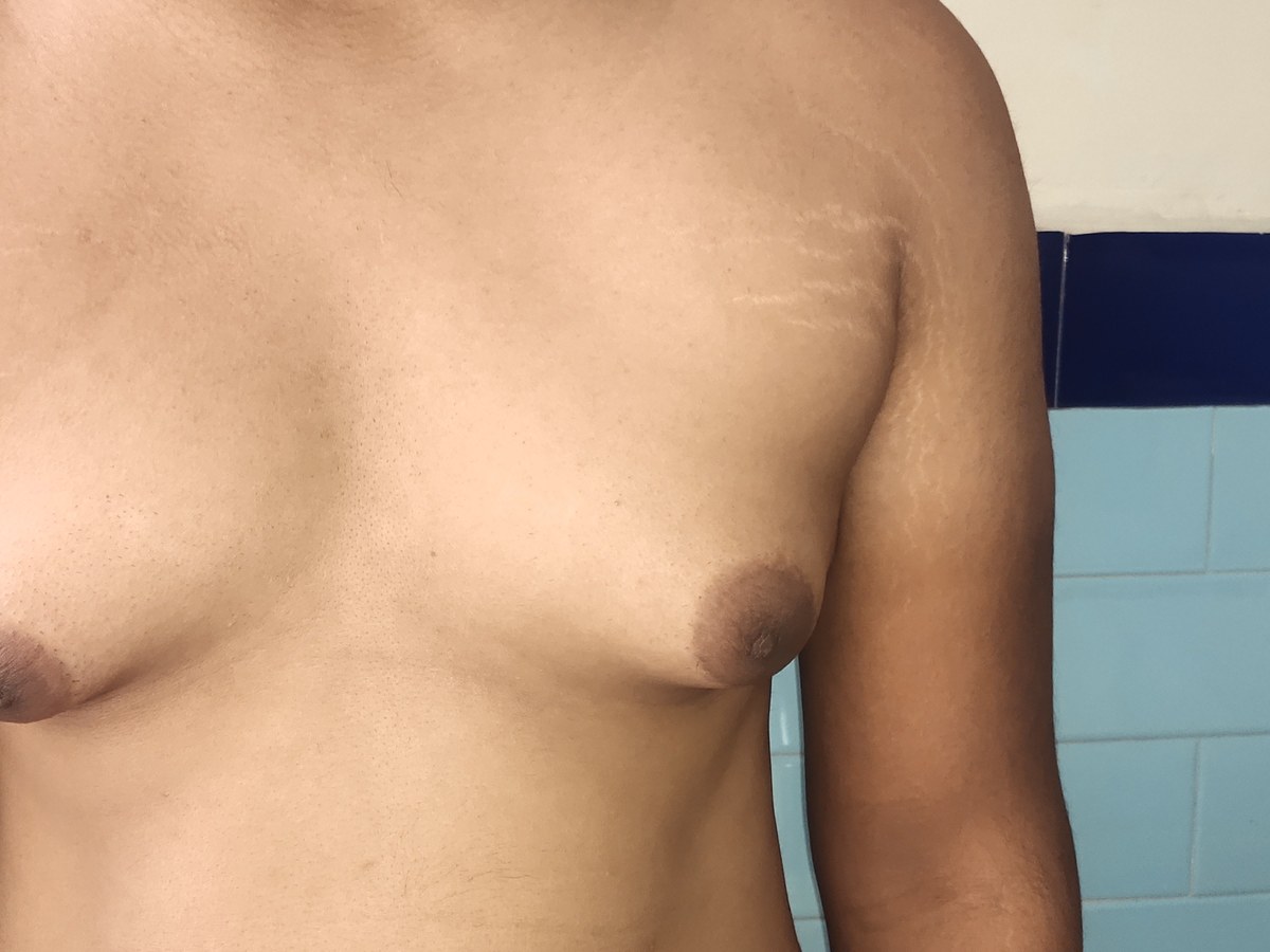 Gynecomastia, before