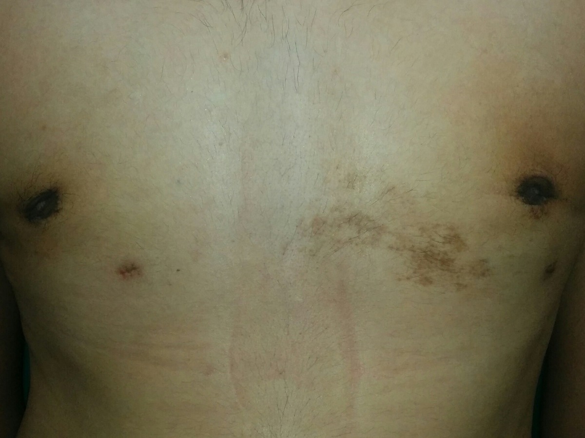 Gynecomastia, after
