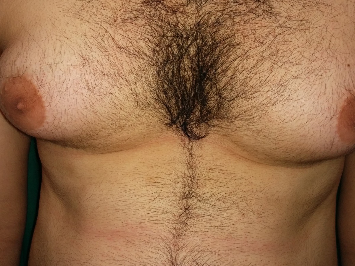 Gynecomastia, before
