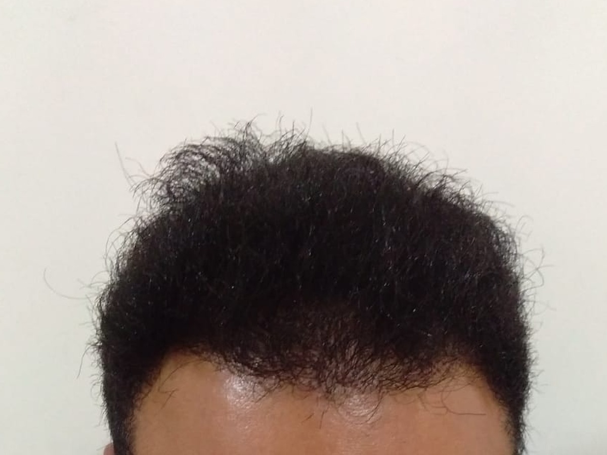 Hair Transplant, after