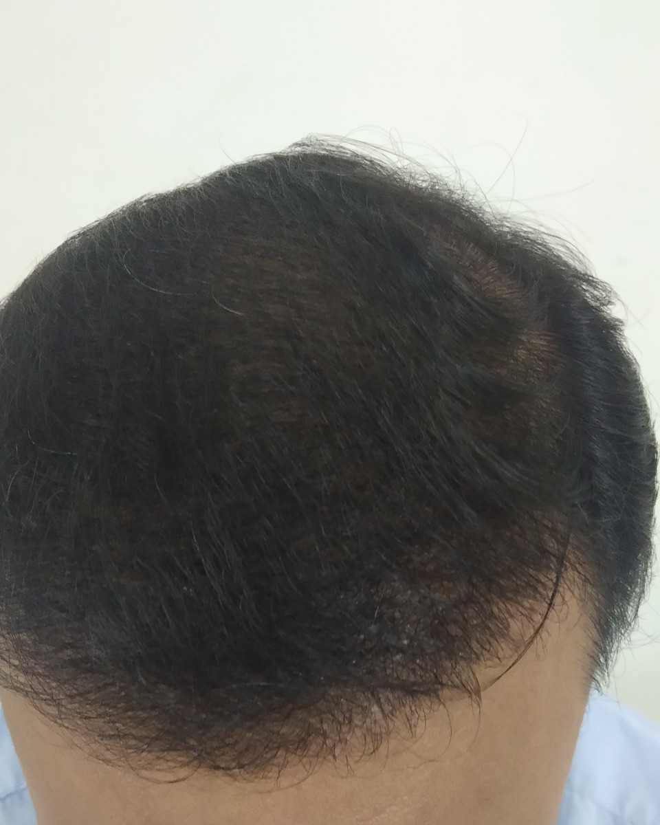 Hair Transplant, after