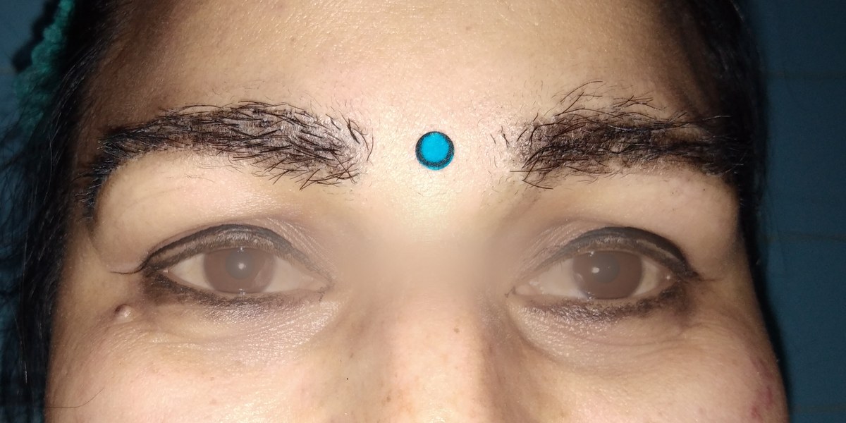 Eyebrow Hair Transplant, after