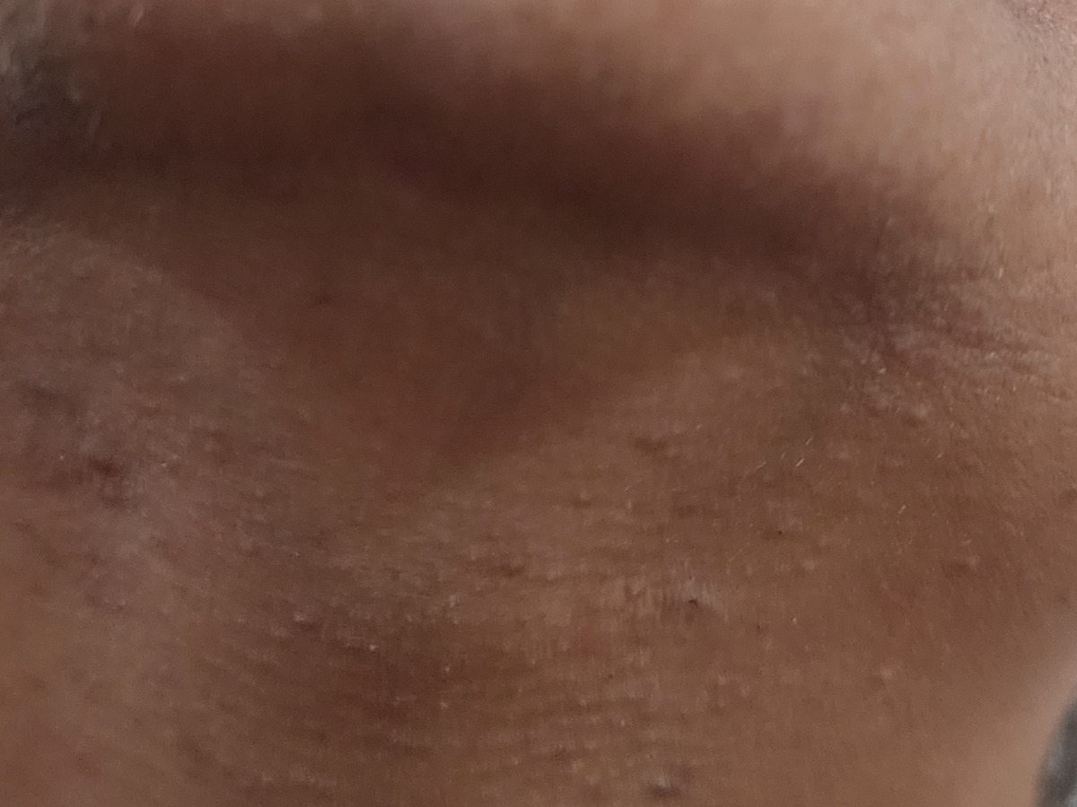 Laser Hair Removal, after
