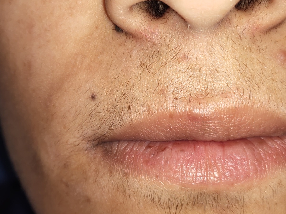 Laser Hair Removal, after