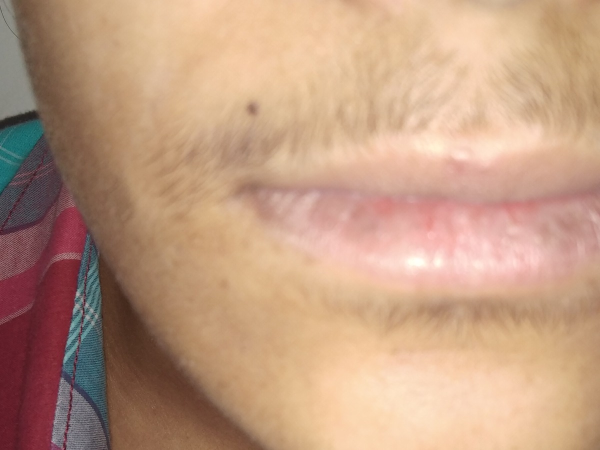 Laser Hair Removal, before