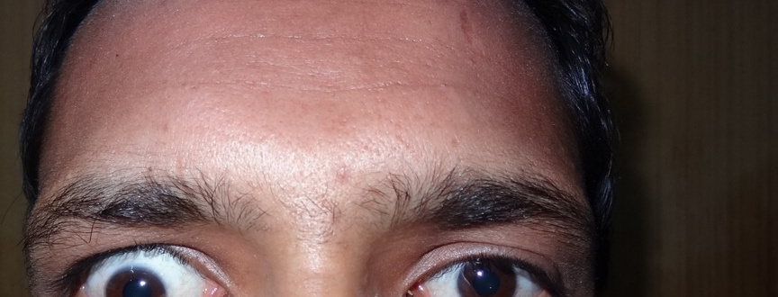 Lid Retraction, before