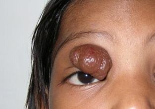 Lid Tumor, before