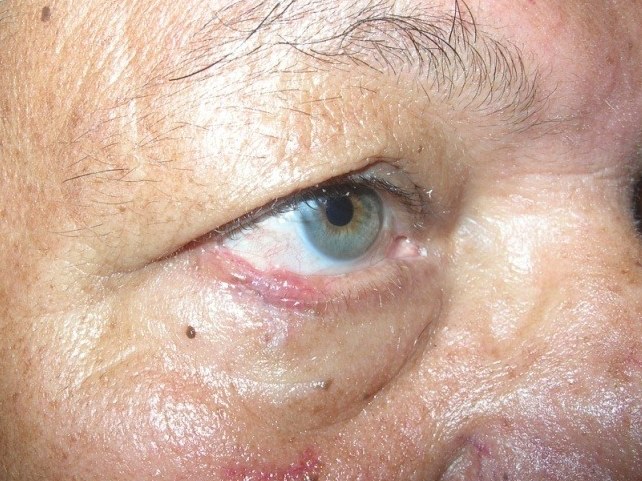 Lid Tumor, after