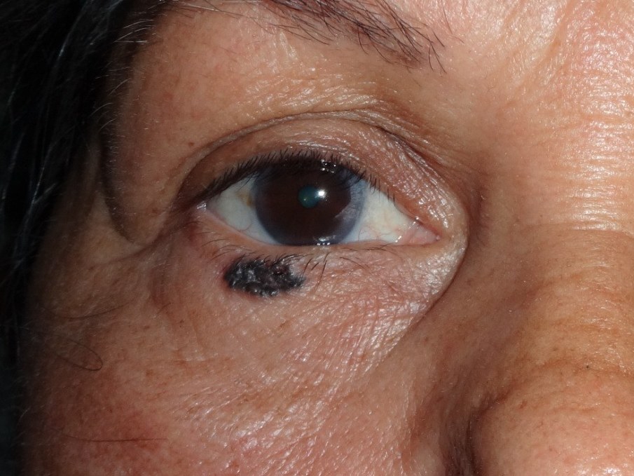 Lid Tumor, before