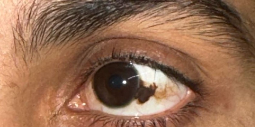 Conjunctival Nevus, before