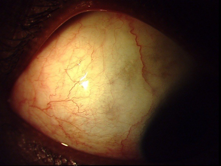 Conjunctival Lymphoma, after