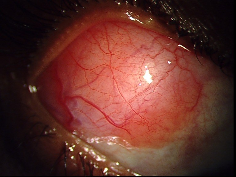 Conjunctival Lymphoma, before