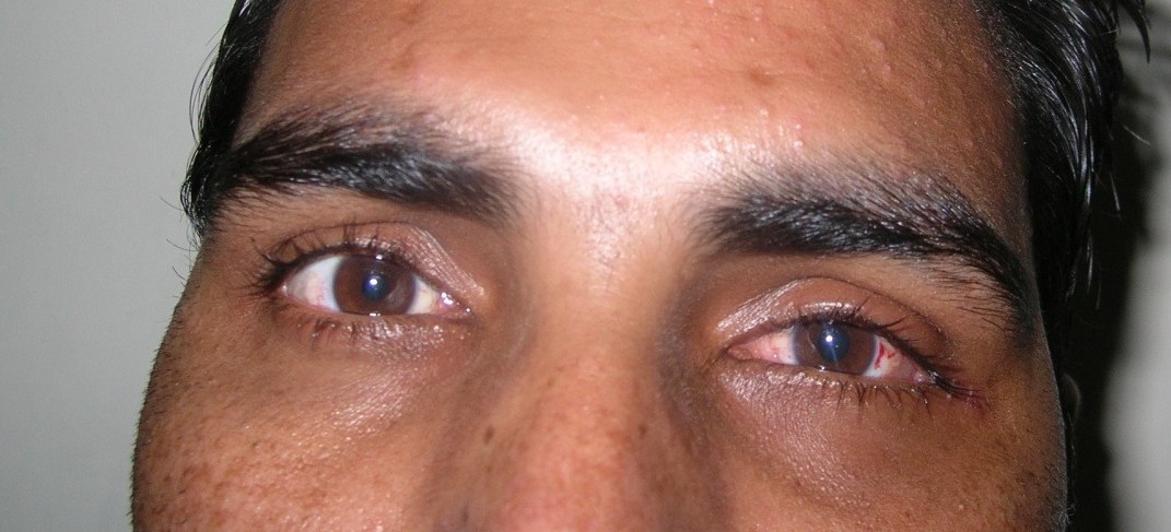 Orbital Floor Fracture, after repair