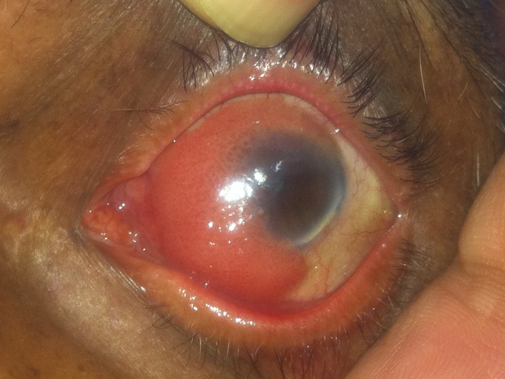 OSSN — Excision with Limbal Stem Cell Transplant, before