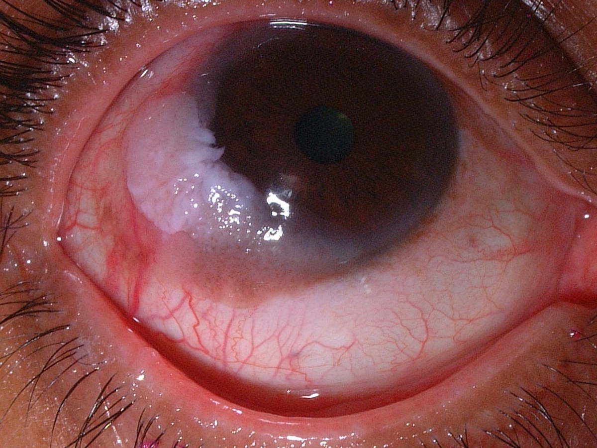 OSSN, before