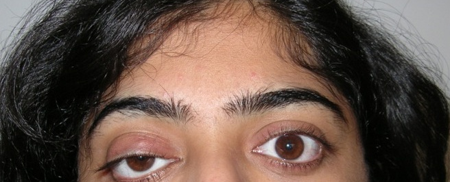 Ptosis — LPS Plication, before