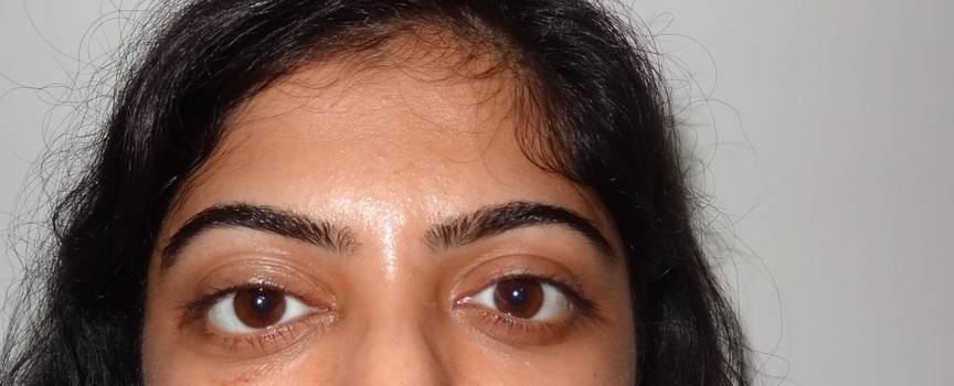 Ptosis — LPS Plication, after
