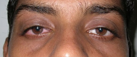 Ptosis — LPS Resection, after