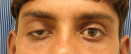 Ptosis — LPS Resection, before