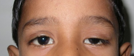 Ptosis — Tarso-Frontal Sling, before