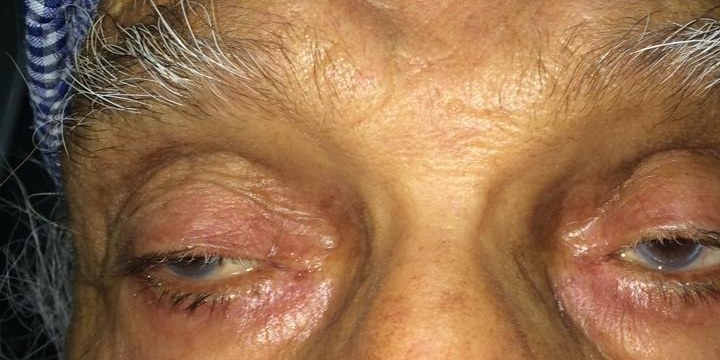 Ptosis, before