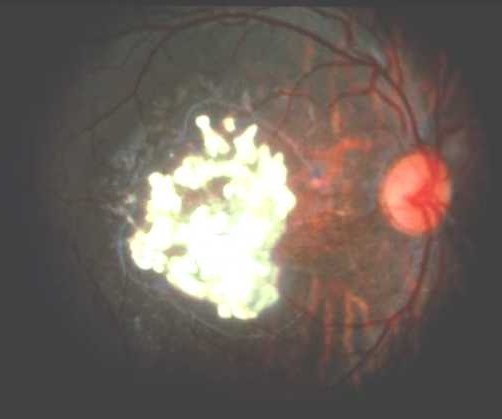 Retinoblastoma, after
