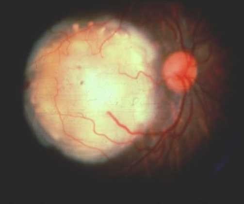 Retinoblastoma, before