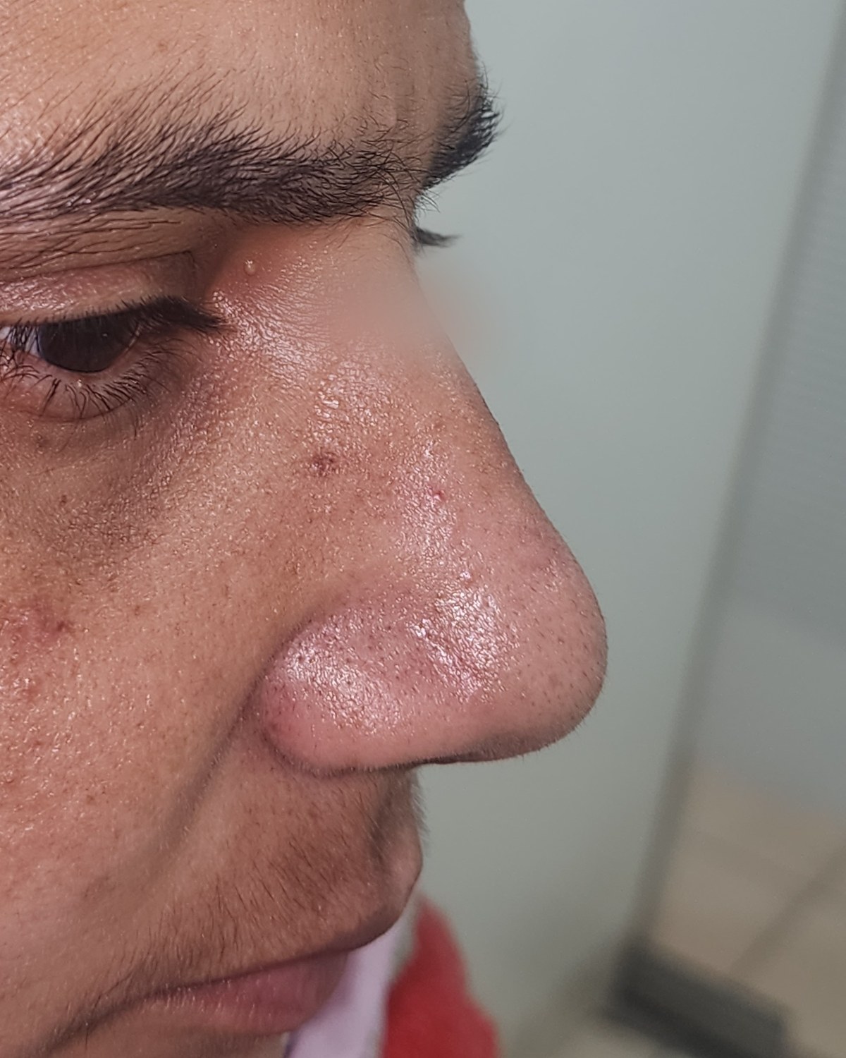 Rhinoplasty, after
