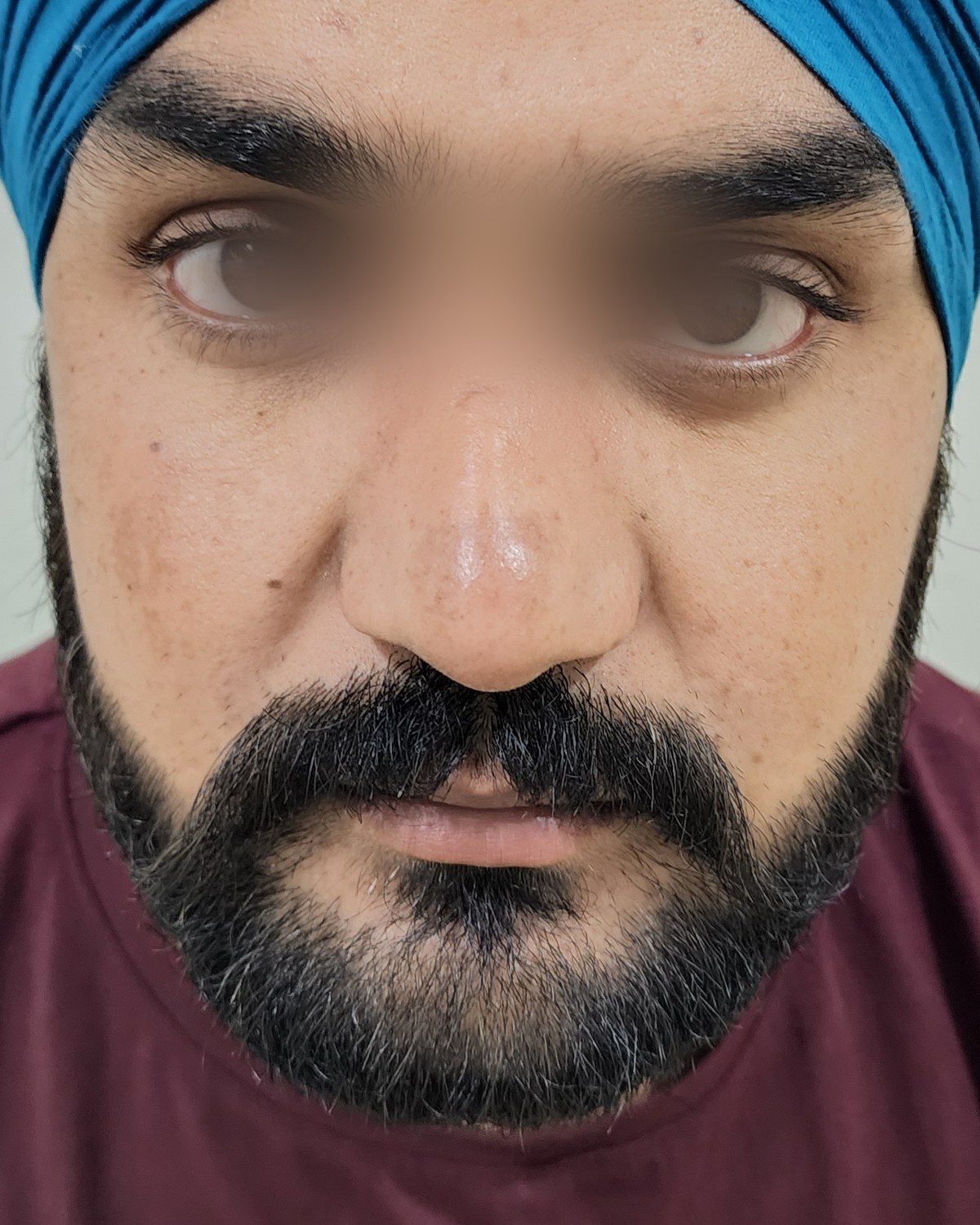 Rhinoplasty, after